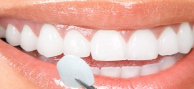 Laminate Veneers